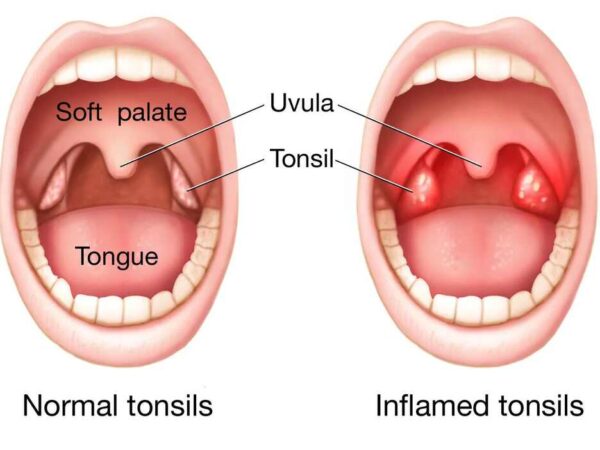 Can Tonsils Grow Back After Being Removed - Tymoff